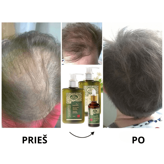 BIO REHAB naudojimas - prieš ir po - šampūnas, kaukė ir tonikas